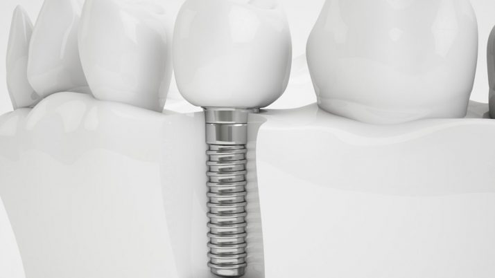 Higiene del implante dental en tres pasos